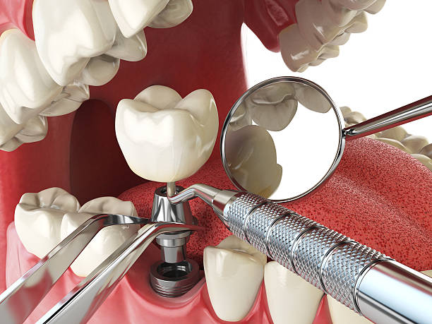 Best Emergency Dentist for Knocked-Out Tooth in Little Falls, NY